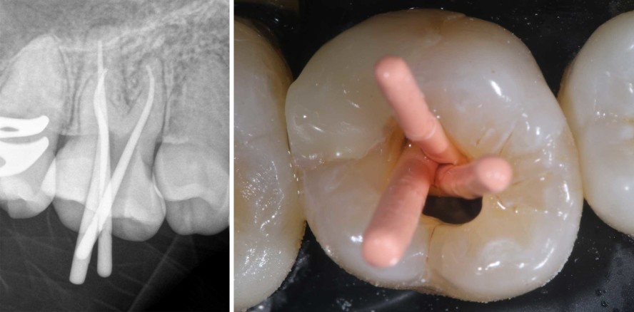 Hygienemanagement bei ungewöhnlicher Zahnstellung