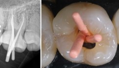 Hygienemanagement bei ungewöhnlicher Zahnstellung