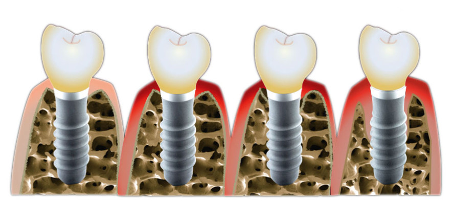Implantate bei Parodontitispatienten – Dürfen wir das?
