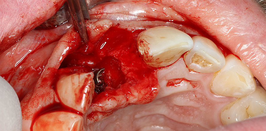 Implantatfraktur bei Sofortversorgung