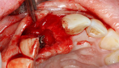 Implantatfraktur bei Sofortversorgung