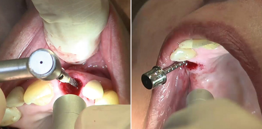 Implantation ohne Lappenbildung: entzündungs- und schmerzarm