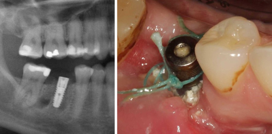 Reparatur-Chirurgie: Implantatmisserfolg und dann?