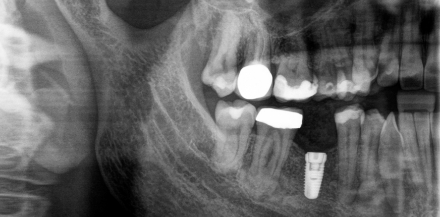 Implantattherapie beim Vorliegen einer zemento-ossären Dysplasie