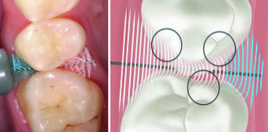 Interdentalraumbürsten für effiziente Biofilmentfernung