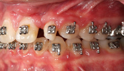 Interdisziplinäre Rehabilitation eines komplexen Patientenfalles mit unilateraler LKG-Spalte