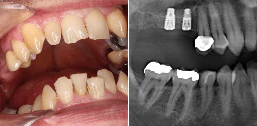 Intralift mittels Piezoelektrischer Chirurgie und Augmentation