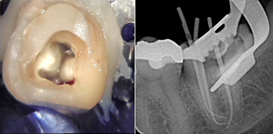 Strategien zur Behandlung extrem gekrümmter Wurzelkanäle