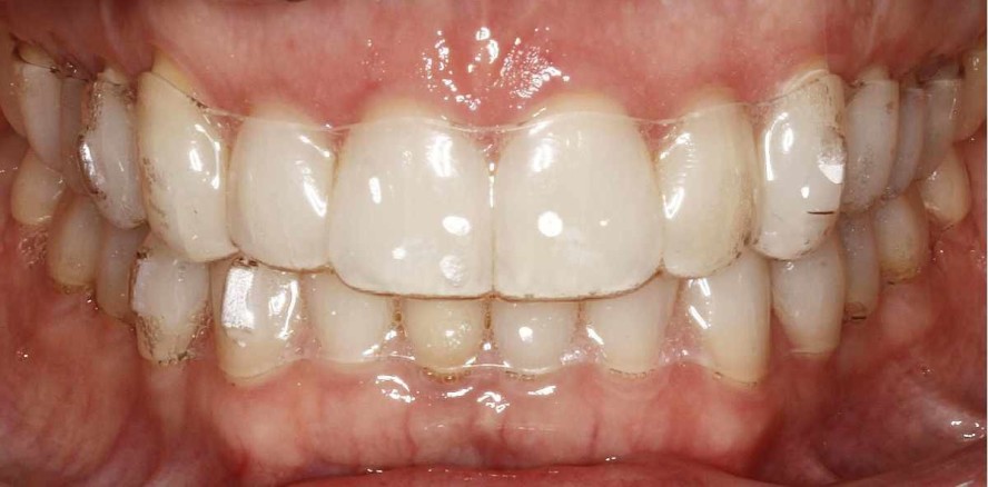 Optimale Kombination von kieferorthopädischen Tools