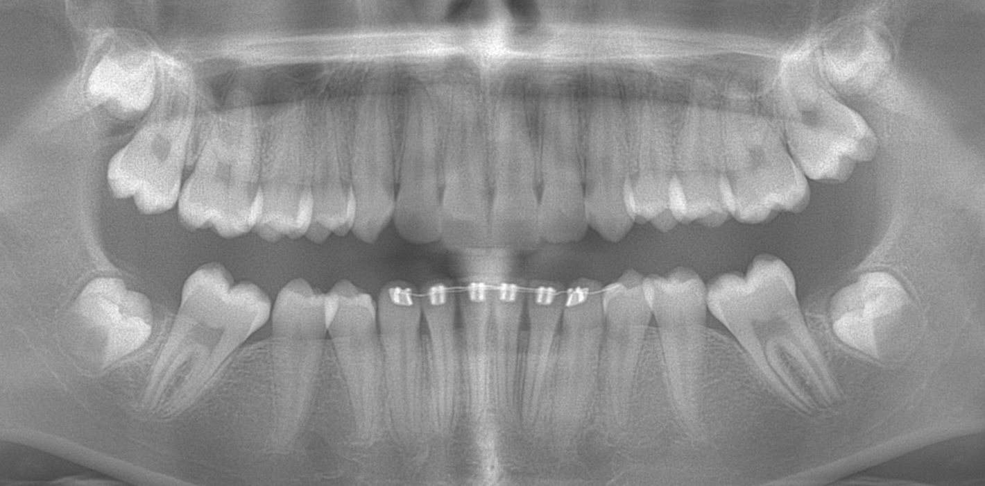 Gesteuerte Extraktion und kieferorthopädischer Lückenschluss – eine Behandlungsoption bei MIH