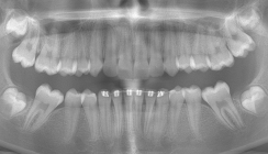 Gesteuerte Extraktion und kieferorthopädischer Lückenschluss – eine Behandlungsoption bei MIH