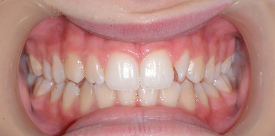 Do-it-yourself-Aligner für leichte Zahnbewegungen