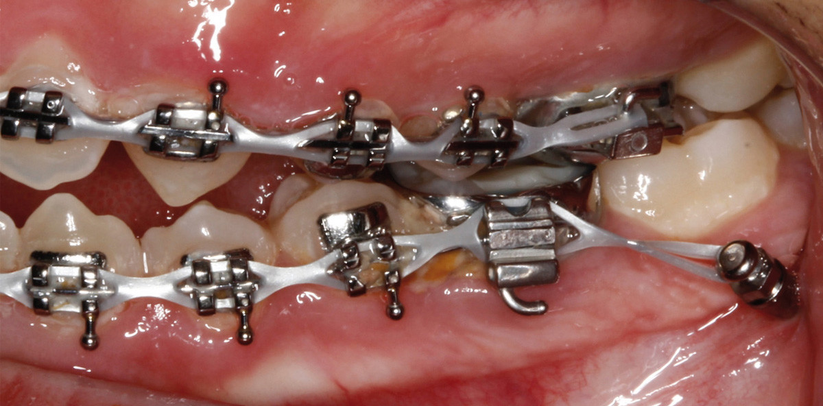 Optimale Planung und Insertion von Minischrauben