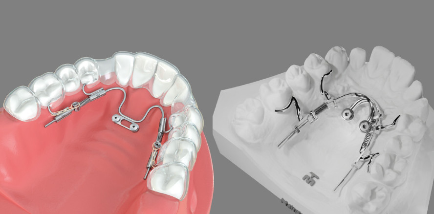 Die neue BAT-Technik – effektive Erweiterung der Alignertherapie