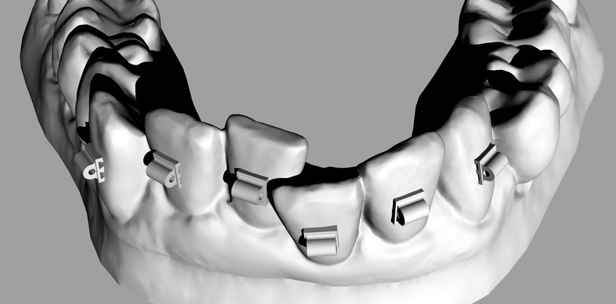 Orthodontische Minitubes zur Korrektur frontaler Engstände