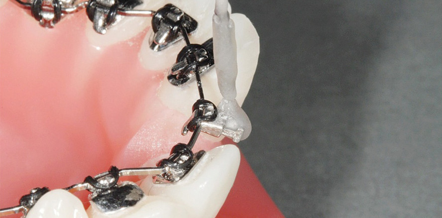 Analyse der Torquekapazität einer individuellen lingualen Apparatur