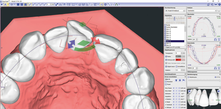 Software und 3D-Druck machen's möglich: Alignertherapie im Eigenlabor herstellen