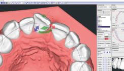Software und 3D-Druck machen's möglich: Alignertherapie im Eigenlabor herstellen