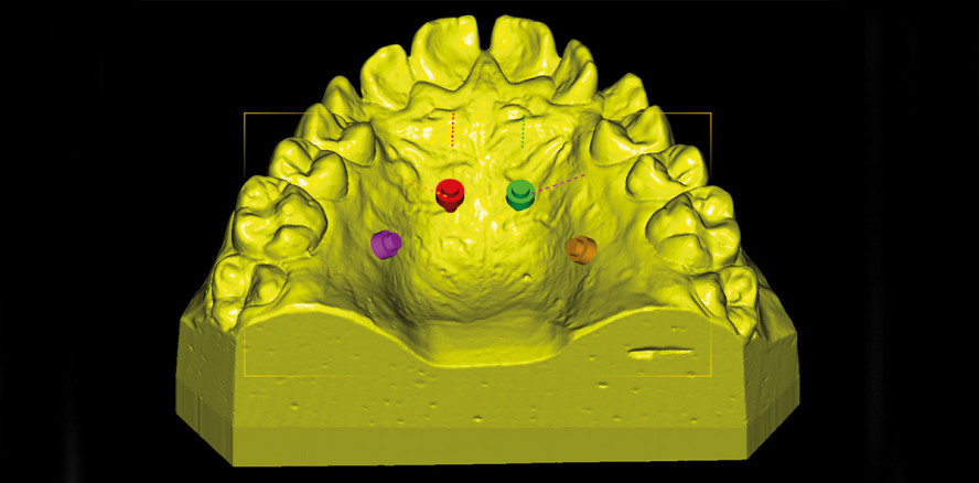 CAD/CAM-Insertionsschienen für rein skelettal verankerte GNE