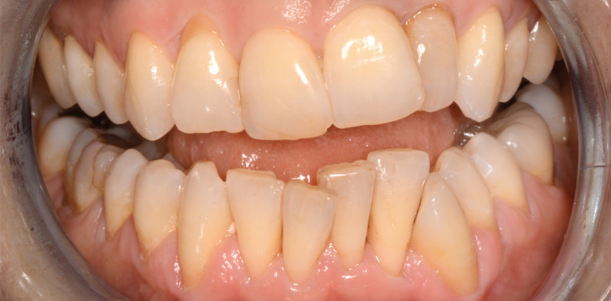 Alignertherapie – nicht nur für einfache Fälle!