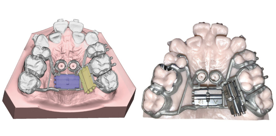 Planung und Fertigung: KFO-Apparaturen virtuell designen
