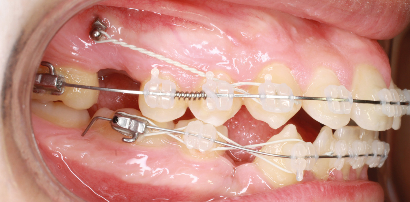 Therapie von Engstand und Protrusion mithilfe nicht alltäglicher Extraktionen