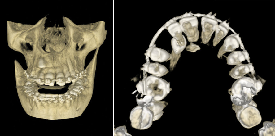 Die Therapie verlagerter Zähne als multidisziplinäre Behandlungsaufgabe