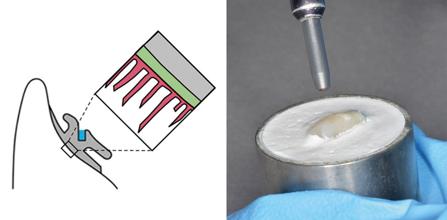 Sandstrahlen: Bessere Verbundfestigkeit von Kunststoff auf Schmelz