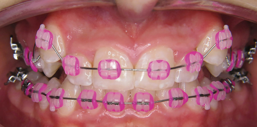 Einordnung bukkal verlagerter Eckzähne im Oberkiefer