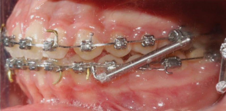 Effektive, mitarbeitsunabhängige Therapie von Klasse II-Malokklusionen