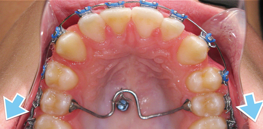 Temporäre skelettale Verankerung: Fehlervermeidung