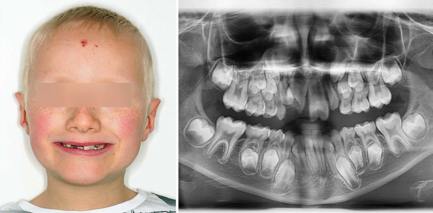 Kein alltäglicher Fall im kieferorthopädischen Praxisalltag
