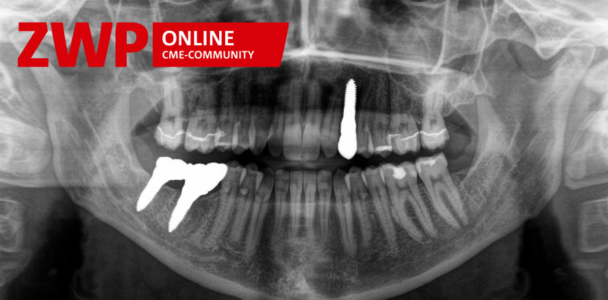 Keramikimplantate – Einsatz in der ästhetischen Zone