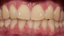 Kiefergelenkarthrose, Diskus­luxation und sequenzielle Aligner