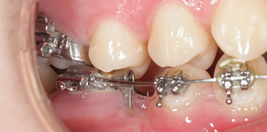 Miniplatten zur skelettalen Verankerung im Unterkiefer