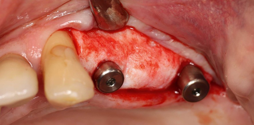 Case Report: Knochenaufbau mit Tentpole-Technik
