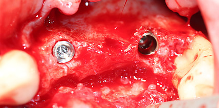 Knochenaufbau mit titanverstärkter ePTFE-Membran und Membranschrauben