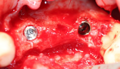 Knochenaufbau mit titanverstärkter ePTFE-Membran und Membranschrauben