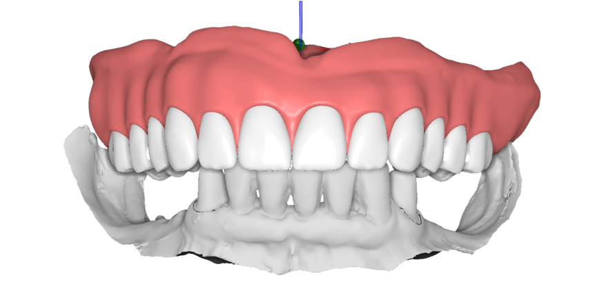 Kombiarbeit und digitale Totalprothetik – Effizienz durch CAD/CAM mit SLM-Verfahren