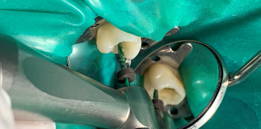 Einfache Kanalaufbereitung für Allrounder und Spezialisten