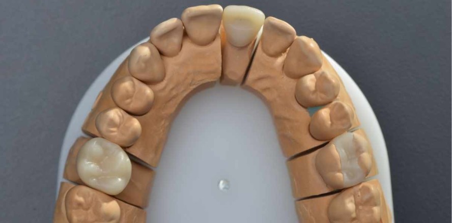 Indirekte Komposite für das CAD/CAM-Verfahren