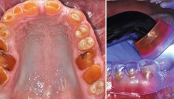 Kompositrestauration bei Amelogenesis imperfecta