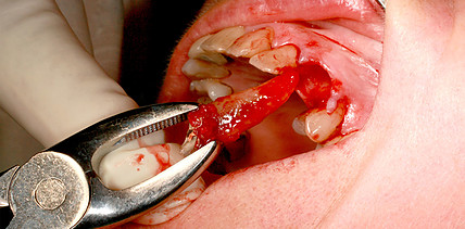 Labial kompromittierte Alveole: Versorgung mit Magnesiummembran