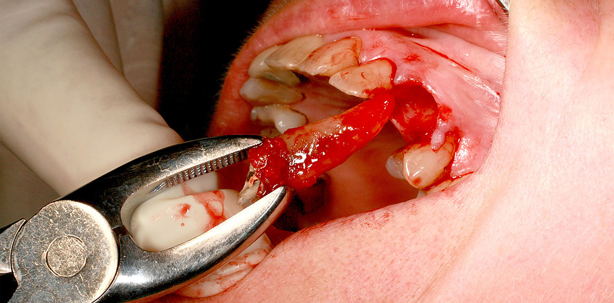 Labial kompromittierte Alveole: Versorgung mit Magnesiummembran