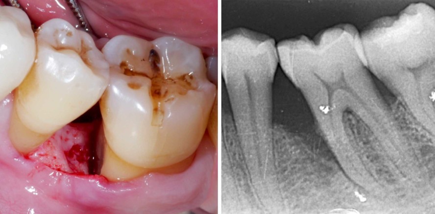 Langzeitstabilität bei vertikalen Knochendefekten