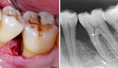 Langzeitstabilität bei vertikalen Knochendefekten
