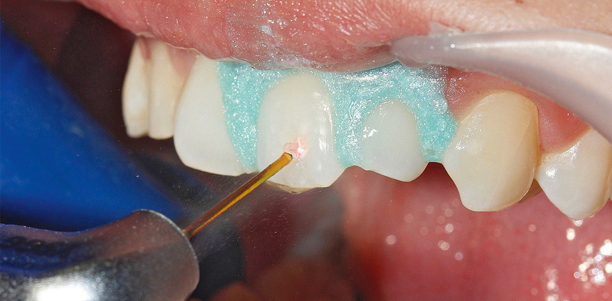 Minimalinvasive Zahnheilkunde mit dem Er,Cr:YSGG-Laser