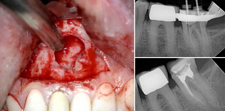 Leitlinie Wurzelspitzenresektion – was nun?