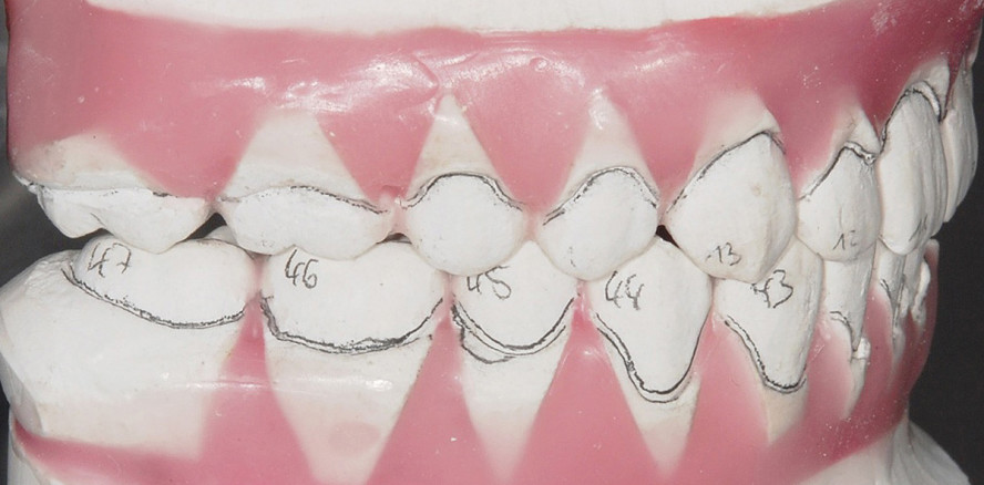 Qualität in der Kieferorthopädie: Die Rolle individueller Apparaturen