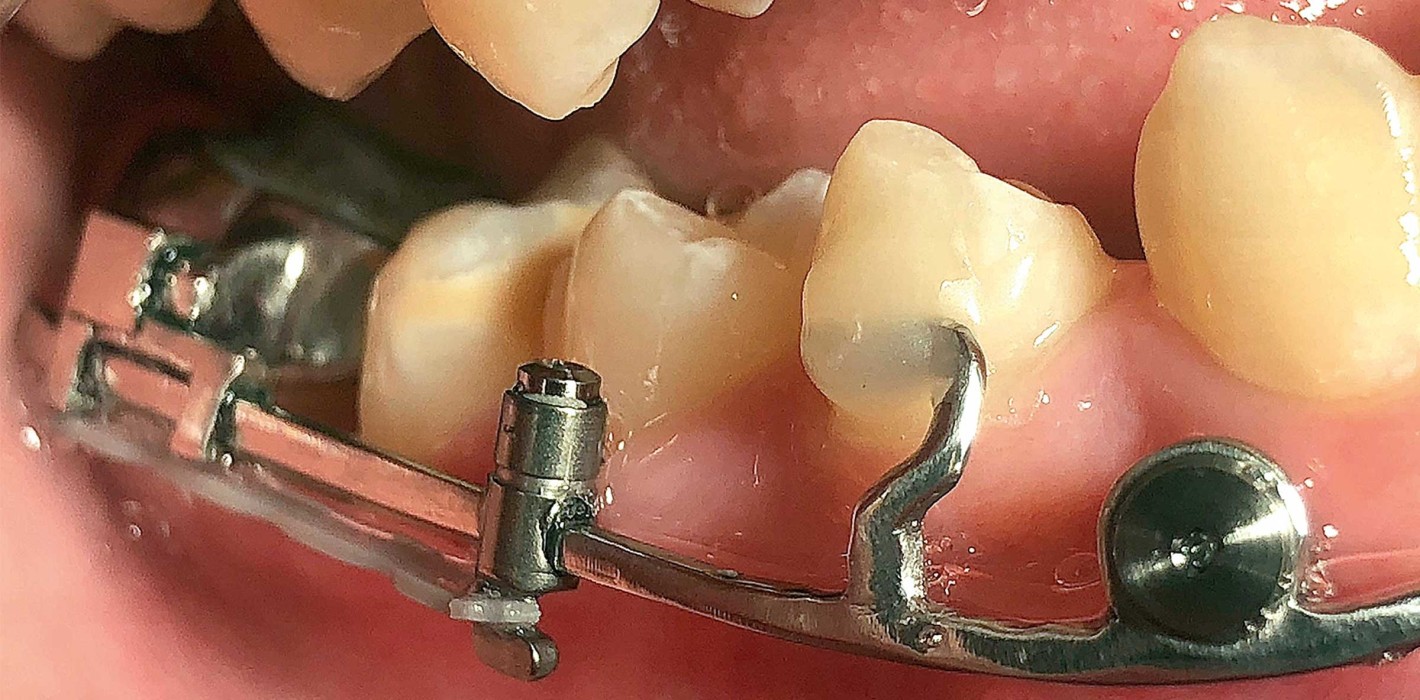 Lückenschluss im Unterkiefer mit CAD/CAM-Mesialslider und Alignern